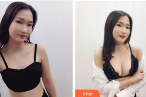 成都華顏醫(yī)療美容門(mén)診部王平整形價(jià)格表附濃縮豐胸真實(shí)案例展示