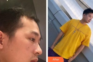 成都風(fēng)尚格致醫(yī)學(xué)美容整形醫(yī)院余正倫副教授 整形價(jià)格表附發(fā)際線(xiàn)案例展示