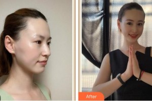 成都美容整形醫(yī)院任華英整形價(jià)格表附水氧案例展示