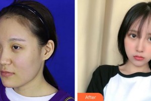 成都華顏醫(yī)療美容門(mén)診部王平整形價(jià)格表附鼻部手術(shù) 面部吸脂案例展示