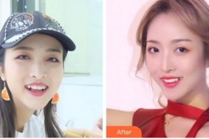 成都美容整形醫(yī)院鄺倫整形價(jià)格表附隱形托槽矯正案例展示