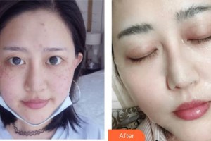 成都美瑞皮膚美容門(mén)診部鄭可揚(yáng)整形價(jià)格表附激光祛斑案例展示