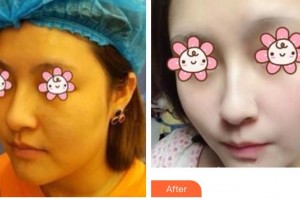 成都美瑞皮膚美容門(mén)診部高淑華整形價(jià)格表附激光祛斑案例展示