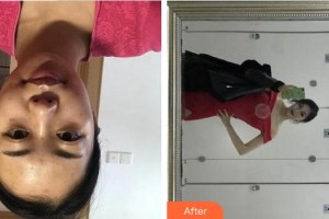 成都大華醫(yī)學(xué)美容醫(yī)院吳振裘整形價(jià)格表附點(diǎn)陣激光案例展示