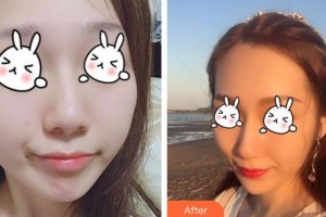 成都第六人民醫(yī)院醫(yī)學(xué)整形美容科趙蓉整形價(jià)格表附無針?biāo)獍咐故?>
</a>
<h3 class=