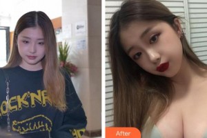 成都瑞美薈醫(yī)療美容醫(yī)院薛瑞整形價(jià)格表附假體隆胸案例展示