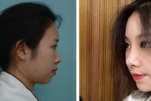 成都花田醫(yī)療美容門診部肖立范整形價(jià)格表附鼻部手術(shù)案例展示