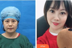 成都莊醫(yī)生醫(yī)學(xué)美容診所管太軍整形價(jià)格表附不開刀祛眼袋+自體脂肪填充淚案例展示