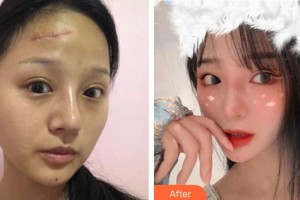 成都醫(yī)學(xué)院第一附屬醫(yī)院燒傷整形科劉月明整形價(jià)格表附離子束祛疤案例展示