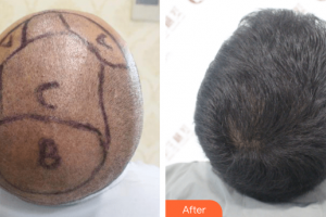 廣州新發(fā)現(xiàn)植發(fā)連鎖機(jī)構(gòu)伍喜進(jìn)整形價(jià)格表附頭發(fā)種植案例展示