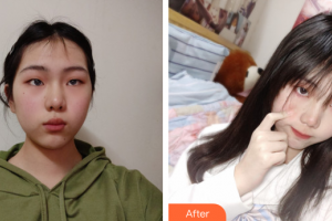 廣州膚美美容醫(yī)院云整形價(jià)格表附超激光美膚案例展示