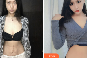 廣州紫馨美容醫(yī)院趙可整形價(jià)格表附激光祛疤案例展示