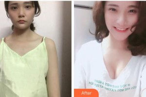 成都醫(yī)美整形美容醫(yī)院廖尚貴整形價(jià)格表附復(fù)合隆胸案例展示