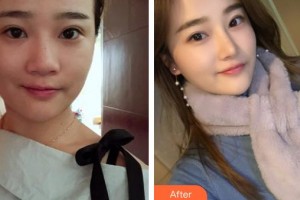 成都莊醫(yī)生醫(yī)學(xué)美容診所李真秀整形價(jià)格表附隆鼻案例展示