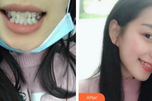 成都悅好醫(yī)學美容醫(yī)院謝蒂整形價格表附瓷貼面案例展示