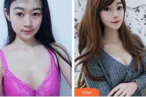 成都艾尚醫(yī)學美容門診部羅利達整形價格表附濃縮豐胸真實案例展示