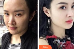 成都晶膚醫(yī)學美容醫(yī)院董薇薇整形價格表附抗皺案例展示