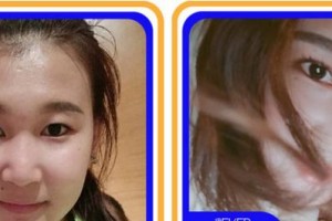 成都伊莎貝拉醫(yī)療美容門診部曾春梅整形價格表附鼻部綜合案例展示