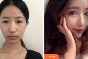 成都悅好醫(yī)學美容醫(yī)院李相穆整形價格表附眼部綜合案例展示