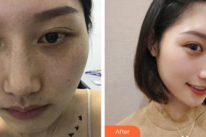 成都悅好醫(yī)學美容醫(yī)院楊艷整形價格表附激光美膚祛斑案例展示