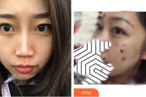 成都悅好醫(yī)學美容醫(yī)院陶曉蘋整形價格表附激光點痣案例展示