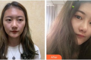 成都悅好醫(yī)學美容醫(yī)院文炯珍整形價格表附鼻部整形案例展示