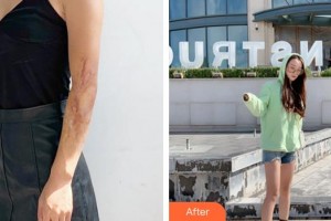 成都碧蓮盛植發(fā)診所袁國安整形價格表附手臂疤痕案例展示