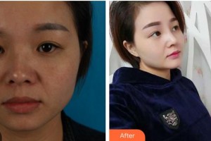 成都天使之翼醫(yī)學美容醫(yī)院郝勁偉整形價格表附鼻部綜合案例展示