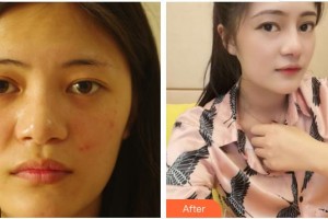 成都維莎芬美容整形醫(yī)院薛美思整形價格表附自體肋骨隆鼻案例展示