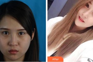 成都悅好醫(yī)學美容醫(yī)院許英哲整形價格表附鼻部手術案例展示