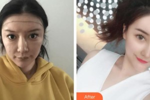 成都空軍醫(yī)院毛發(fā)移植中心王明福整形價格表附種植發(fā)際線案例展示