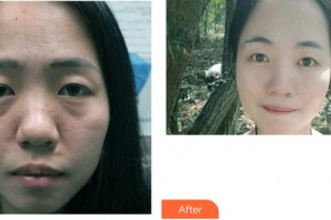 成都美瑞皮膚美容門診部董瀛整形價格表附光子嫩膚案例展示