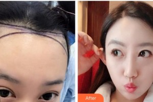 成都西區(qū)醫(yī)院醫(yī)學美容科蔡英整形價格表附發(fā)際線移植案例展示