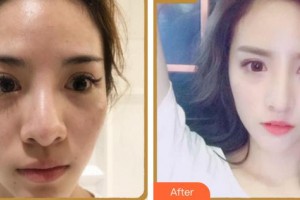 成都天使之翼醫(yī)學美容醫(yī)院李大光整形價格表附鼻部多項案例展示