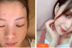 成都米蘭柏羽醫(yī)學美容醫(yī)院肖明月整形價格表附“6D埋線提升”重返年輕案例展示