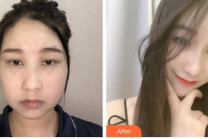 成都米蘭柏羽醫(yī)學美容醫(yī)院張峰整形價格表附埋線提升提升案例展示