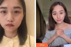 成都米蘭柏羽醫(yī)學美容醫(yī)院盧義整形價格表附熱瑪吉多方面部體驗案例展示