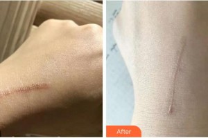 成都西區(qū)醫(yī)院醫(yī)學美容科王春聯(lián)整形價格表附祛疤案例展示