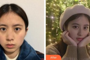 成都花田醫(yī)療美容門診部彭忠整形價格表附超激光美膚平光祛黃案例展示