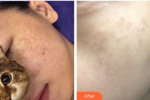 成都唯羅納醫(yī)療美容門診部廖美蓉整形價格表附蜂巢激光美膚激光祛斑案例展示