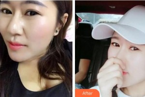 成都米蘭柏羽醫(yī)學美容醫(yī)院林楷貽整形價格表附果酸煥膚案例展示