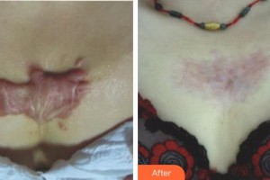 成都錦城整形美容醫(yī)院馮麗萍整形價(jià)格表附綜合調(diào)節(jié)祛疤案例展示