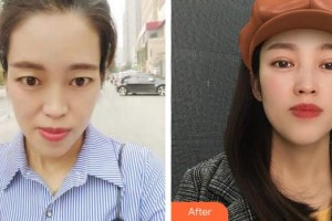 成都可思美醫(yī)學美容門診部潘紅偉整形價格表附眼部整形案例展示