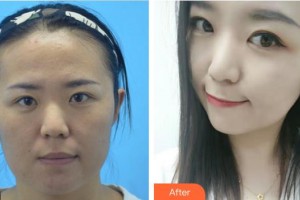 成都恒博醫(yī)院整形美容中心王英整形價(jià)格表附祛斑凈膚案例展示