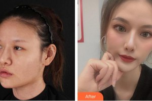 成都永康醫(yī)院整形美容科劉玉輝整形價(jià)格表附眼部整形案例展示