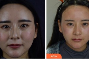 成都華顏醫(yī)療美容門診部楊燕整形價(jià)格表附皮膚管理-美白嫩膚-微針美膚案例展示