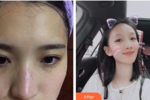 成都華顏醫(yī)療美容門診部張嶸整形價(jià)格表附祛斑案例展示