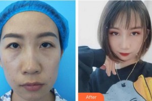 成都錦城整形美容醫(yī)院丁獻(xiàn)松整形價(jià)格表附雙眼皮案例展示