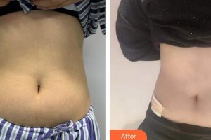 成都藝星醫(yī)療美容醫(yī)院閻偉整形價(jià)格表附腰腹吸脂案例展示