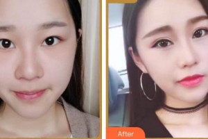 成都濟(jì)慈德美醫(yī)療美容門診部劉家亙整形價(jià)格表附眼部綜合案例展示